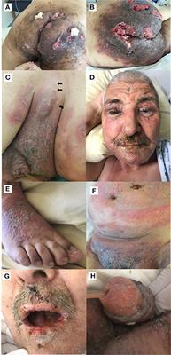 Paraneoplastic Pemphigus Revealed by Anti-programmed Death-1 Pembrolizumab Therapy for Cutaneous Squamous Cell Carcinoma Complicating Hidradenitis Suppurativa